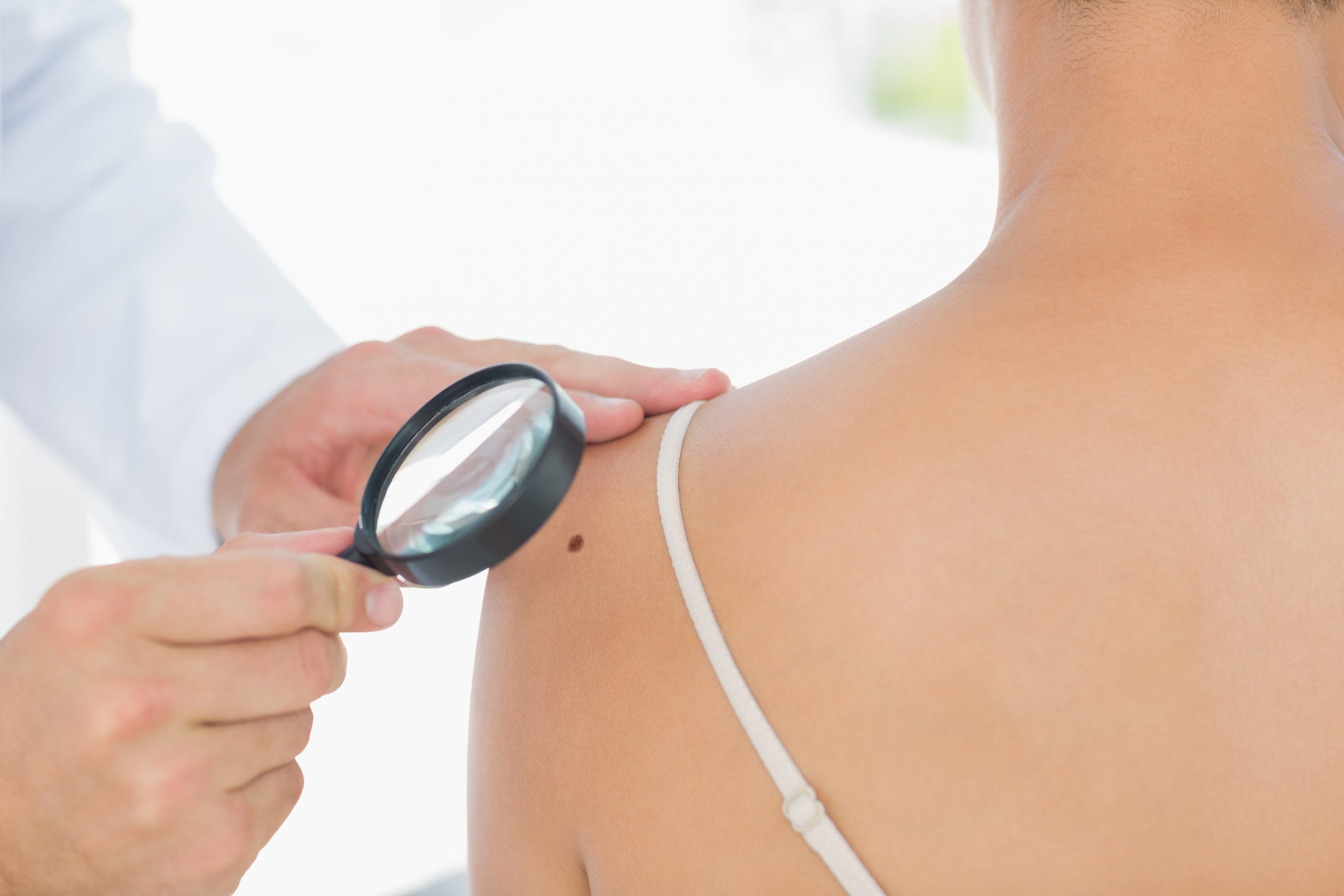 Newport Family Doctors Skin check summer Skin checks skin cancer procedure excision